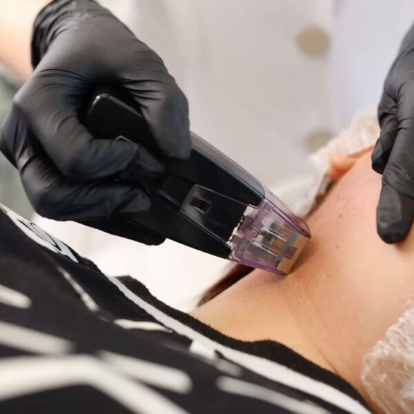 RF Microneedle Lift – ремоделиране и стягане на тялото